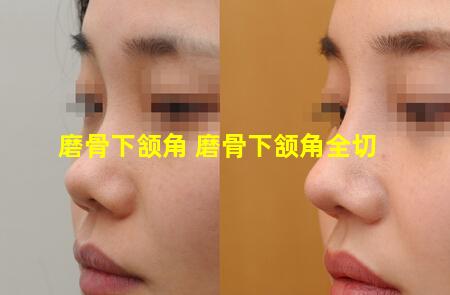 磨骨下颔角 磨骨下颔角全切
